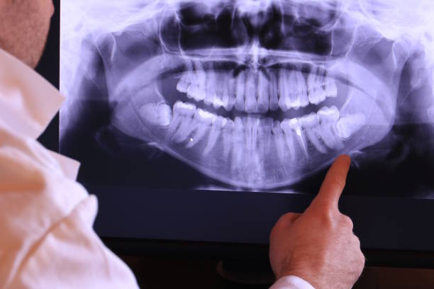 Best Emergency Wisdom Teeth Removal in Saco, ME